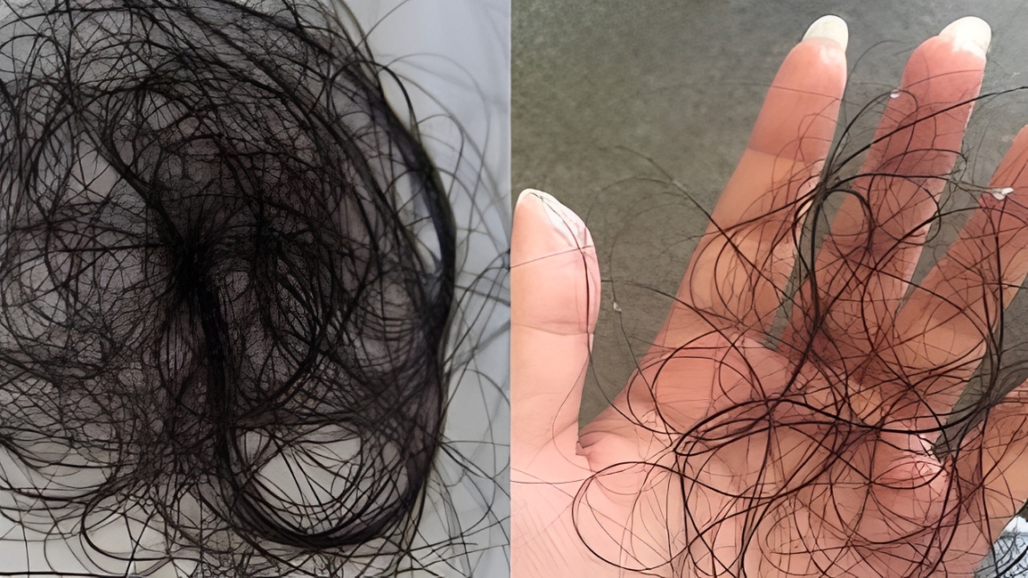 Can-Stress-Cause-Hair-Loss-How-to-Understand-and-Reverse-It