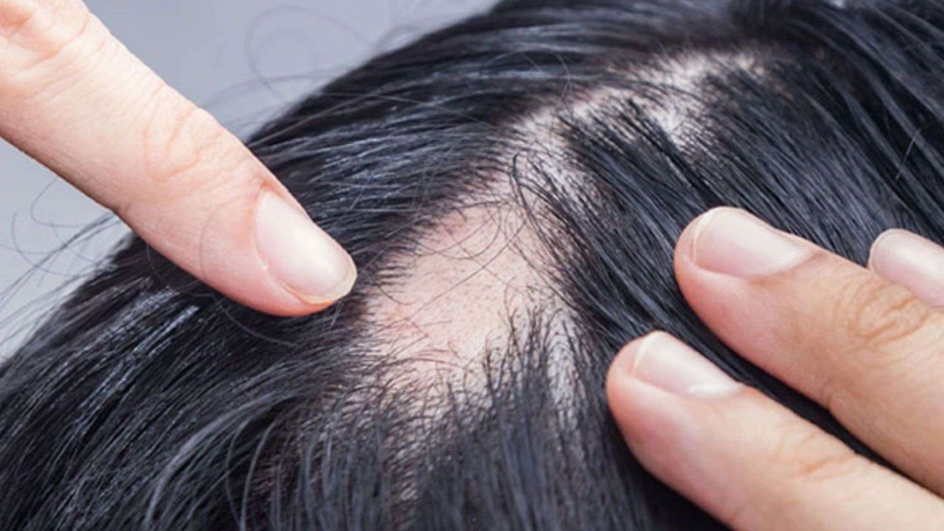 Telogen Effluvium (TE)