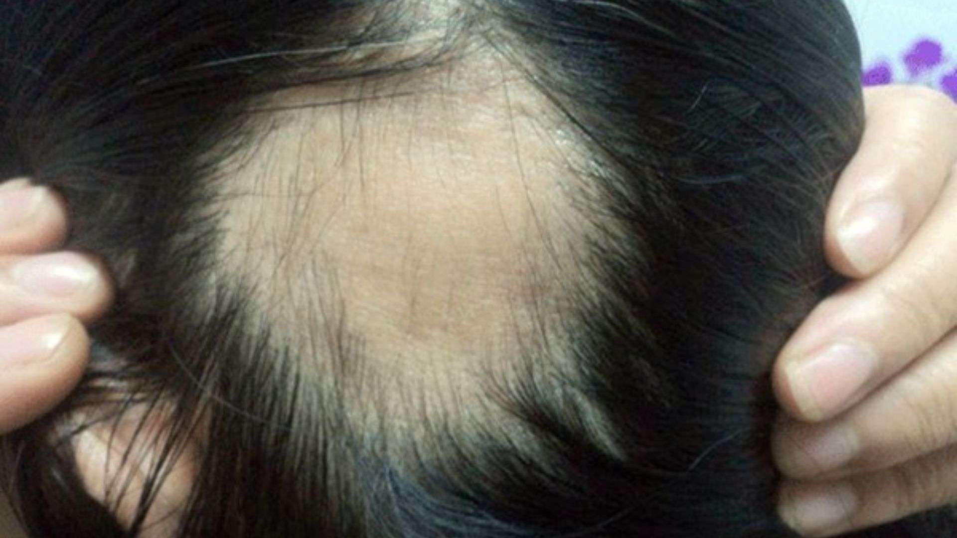 opecia Areata (AA)